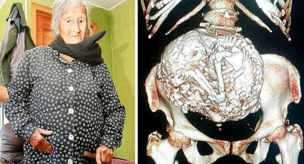 Descubren que una anciana de 92 años lleva en su vientre un feto momificado