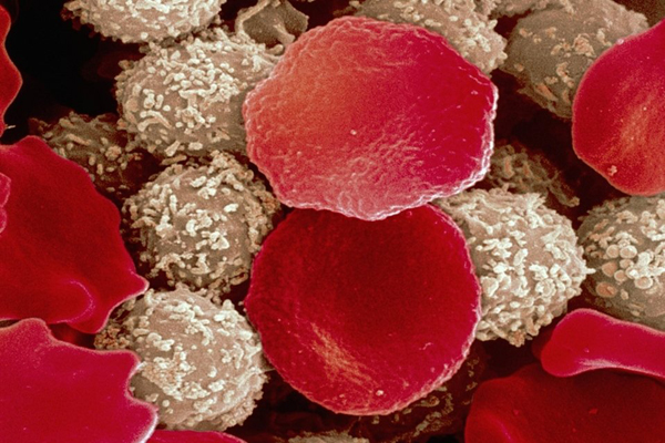 El genoma de la leucemia allana el camino para mejorar los tratamientos