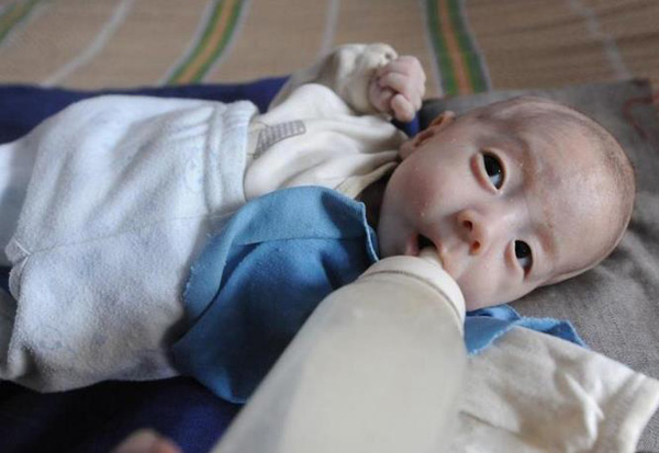Un bebé recibe tratamiento tras nacer sin ano