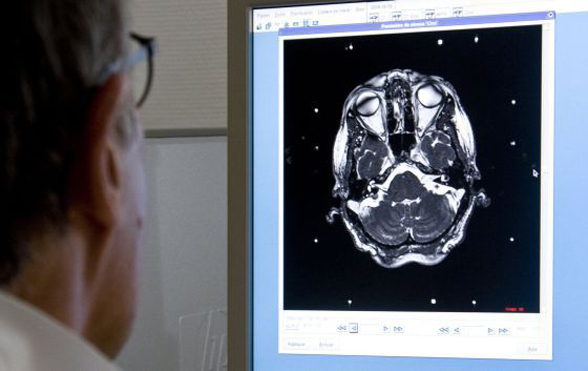 Descubren cómo detectar un tumor cerebral con una punción lumbar