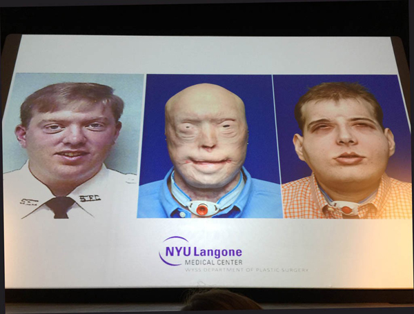 EEUU realiza el trasplante de cara más completo a un bombero de 41 años