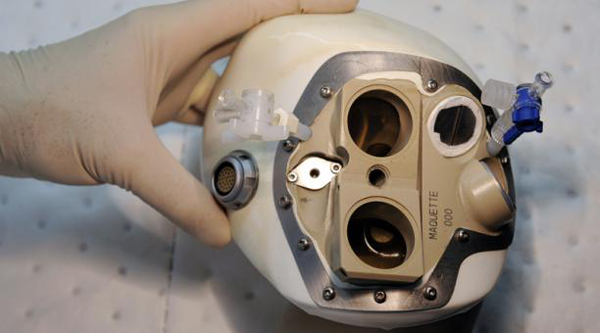Murió tercer paciente con implante de corazón artificial en Francia