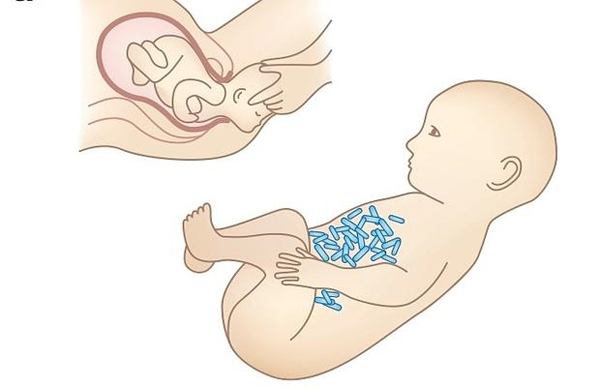 Una técnica restaura las bacterias maternas en 4 niños nacidos mediante cesárea