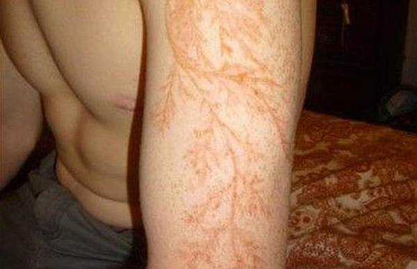 Los extraños «tatuajes» que aparecen en la piel de quienes son alcanzados por un rayo