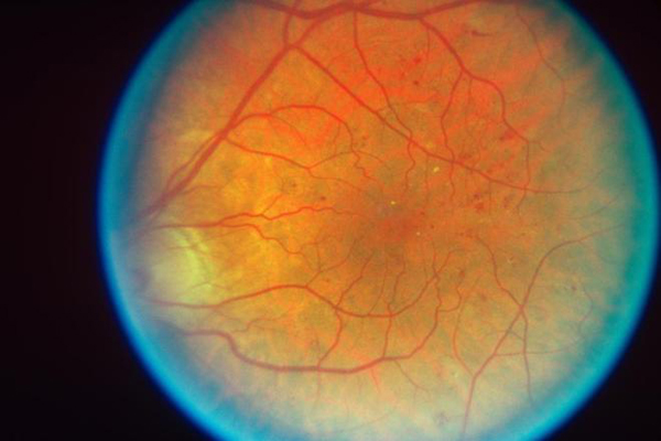Una terapia con células madre regenera el tejido ocular de niños con cataratas