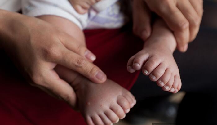 Los padres de un bebé con 31 dedos piden ayuda para su operación