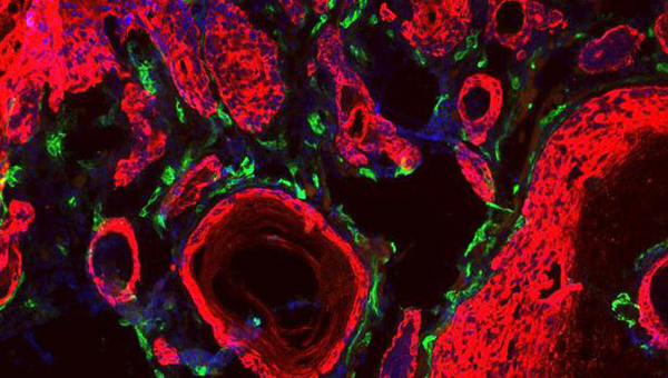 Descubren cómo los tumores asaltan células sanas para formar metástasis