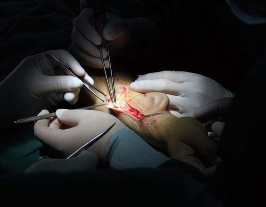 Cirujanos chinos trasplantan oreja regenerada de brazo a cabeza