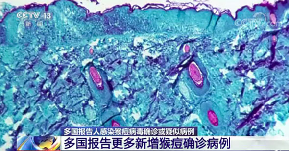 China prepara kits de prueba contra la viruela del mono y podría desarrollar una vacuna “de ser necesario”