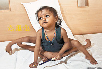 Una niña india nació con cuatro brazos y cuatro piernas,\r\ny se la someterá a una operación quirúrgica