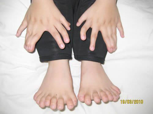 Peng Peng tiene 15 dedos de la mano, y 16 dedos del pie.  31 dedos en total.