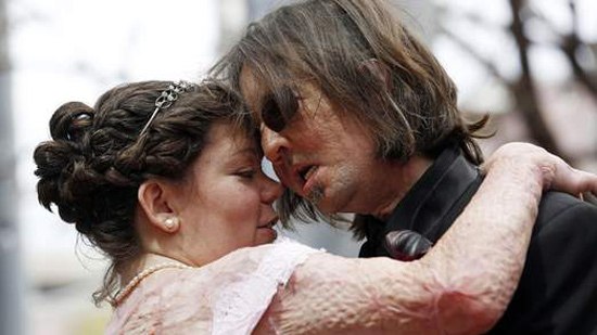 Hombre con primer trasplante de cara en EE. UU. se casa con otra víctima de quemaduras
