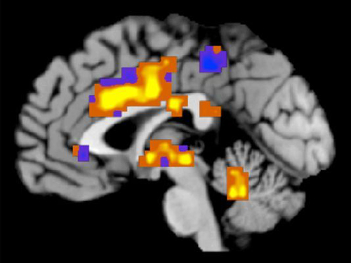 EE.UU.: escaneo del cerebro muestra la imagen del dolor