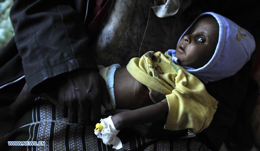 Casi el 60% de los niños de Yemen menores de cinco años sufren de desnutrición