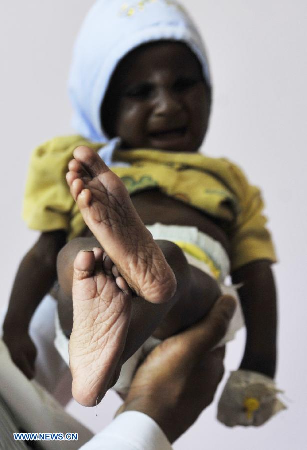 Casi el 60% de los niños de Yemen menores de cinco años sufren de desnutrición