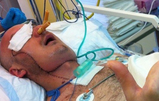 Se realiza en Polonia el primer trasplante total de cara a un hombre accidentado en una cantera
