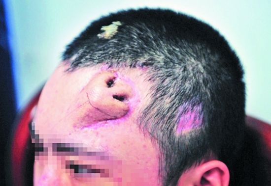 Doctor chino construye nariz en la frente de un hombre