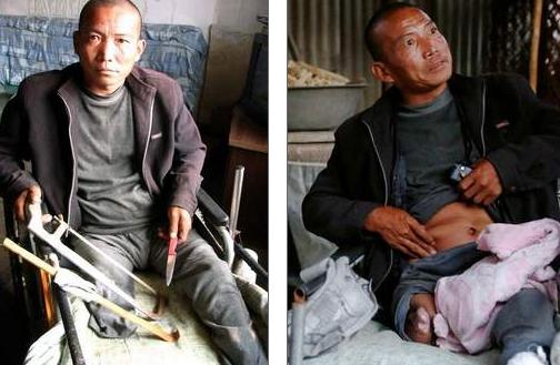 Un hombre en China se amputa la pierna con una sierra por no tener dinero para el hospital