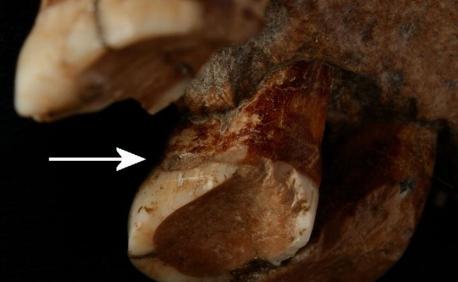 Los neandertales usaban palillos para calmar el dolor relacionado con los dientes