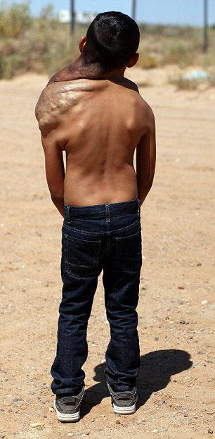 Un niño mexicano con un tumor en el cuello