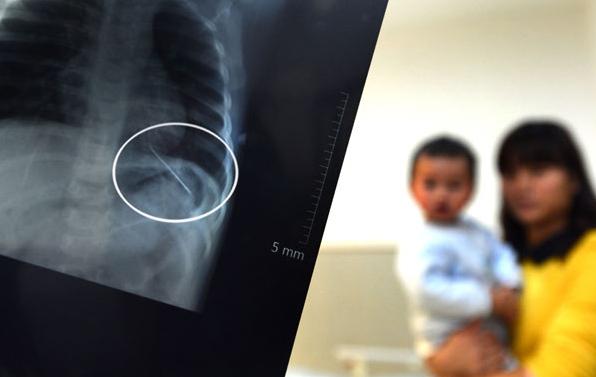 Radiografía revela aguja de 5cm en el pulmón de un niño 