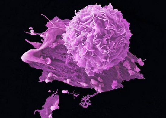 Descubren una sustancia que destruye las células tumorales agresivas