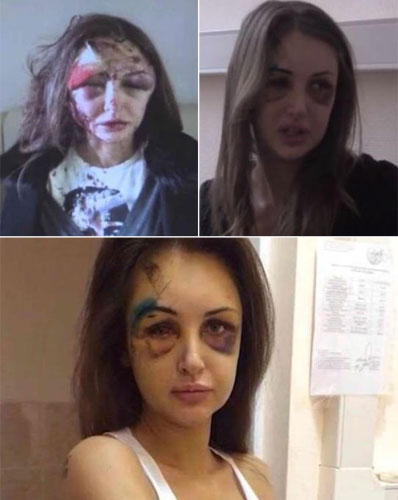 Un millonario ruso huye tras desfigurar el rostro a su novia modelo